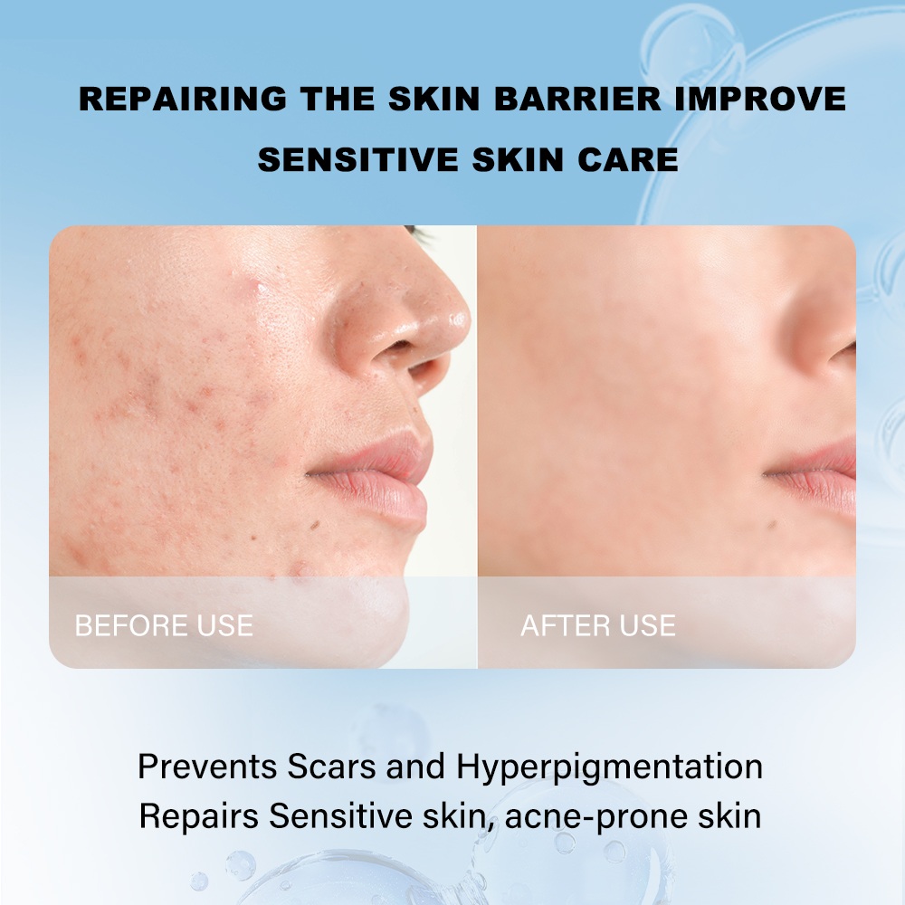 Medical-Grade Recombinant Human Collagen Cream Dressing3