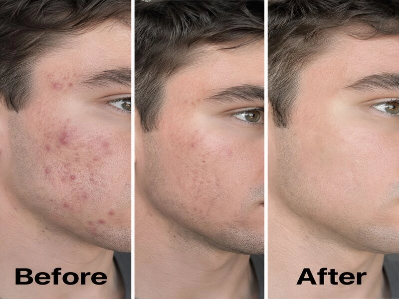 Acne Treatment Case