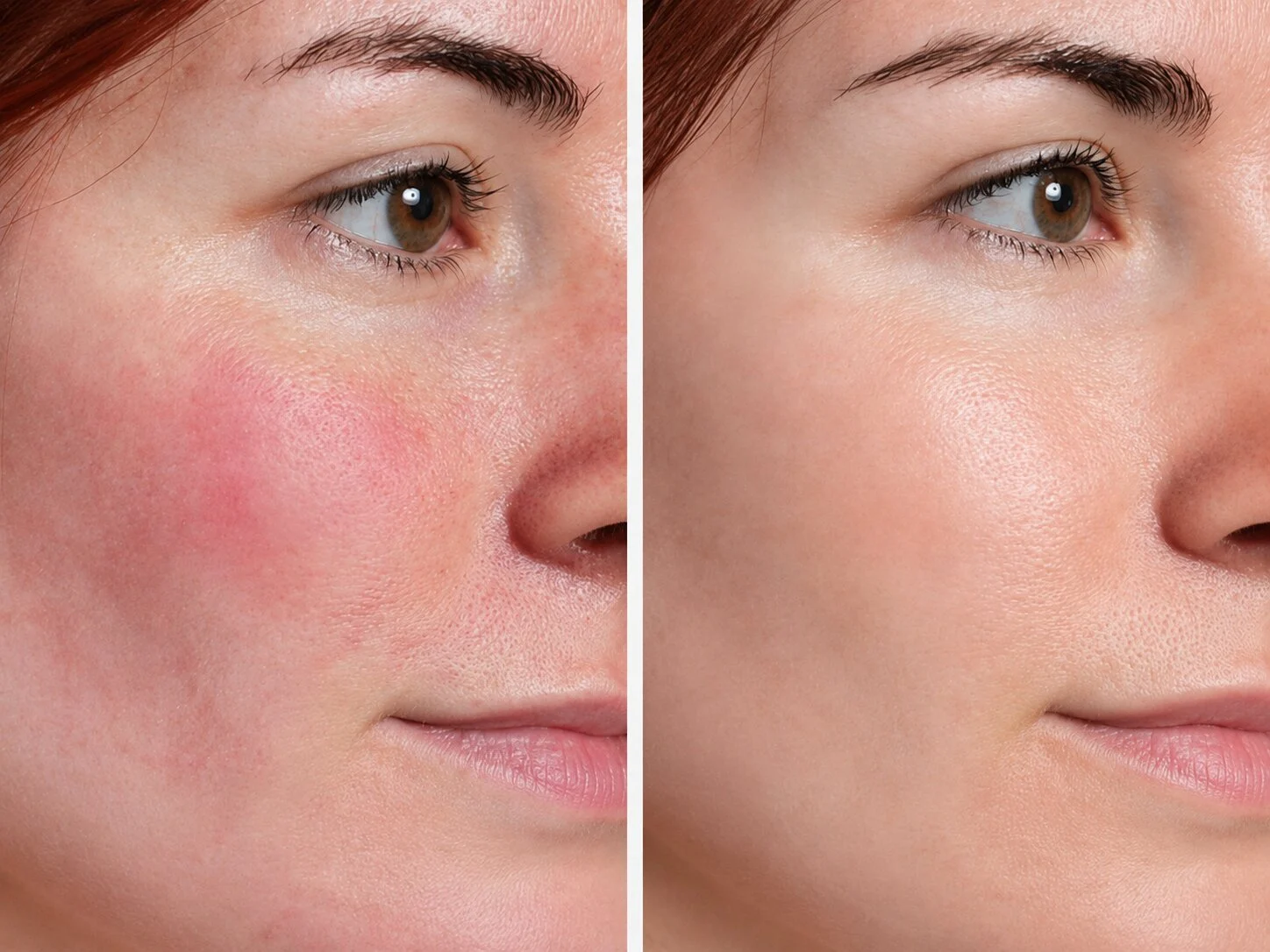 Post-Laser Treatment Recovery Case
