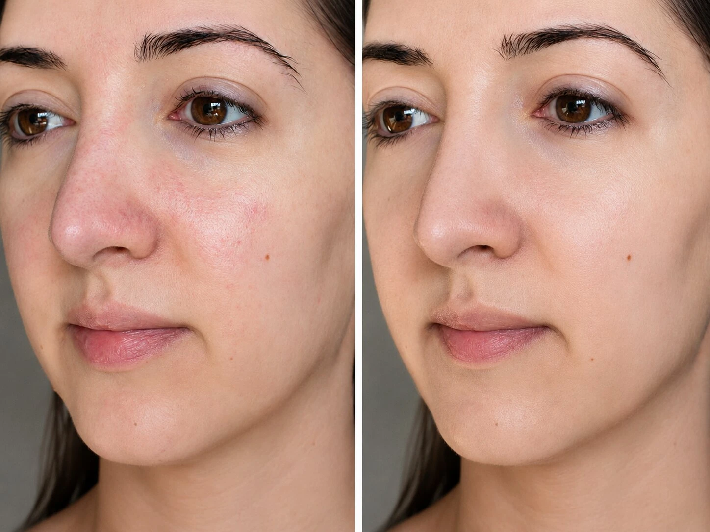Post-Sunburn Repair Case Study